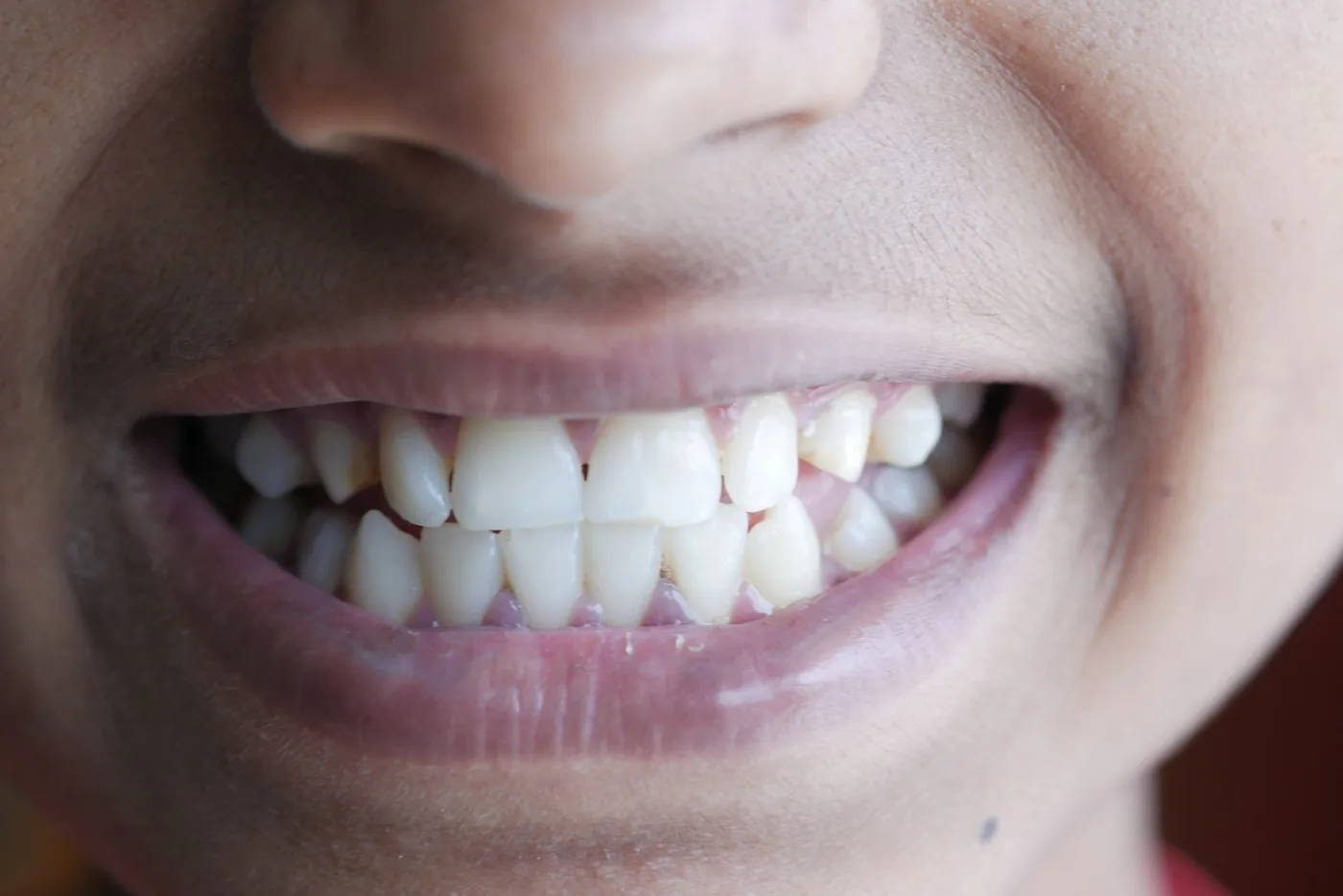 Zubní implantáty: vše, co o nich potřebujete vědět